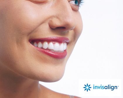 Invisalign - die unsichtbare Zahnspange Praxis für Kieferorthopädie Dr. Baumann St. Gallen