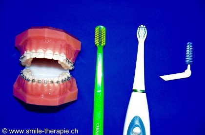 Gute Mundhygiene ist bei Zahnspangen wichtig