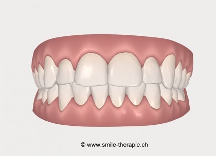 Invisalign Simulation des Behandlungsresultates 