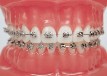 Vergleich herkömmlicher Zahnspangen (links) mit dem Damon® System (rechts)
